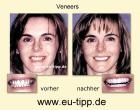 NEUE ZÄHNE in Tschechien - Implantate Euro 490